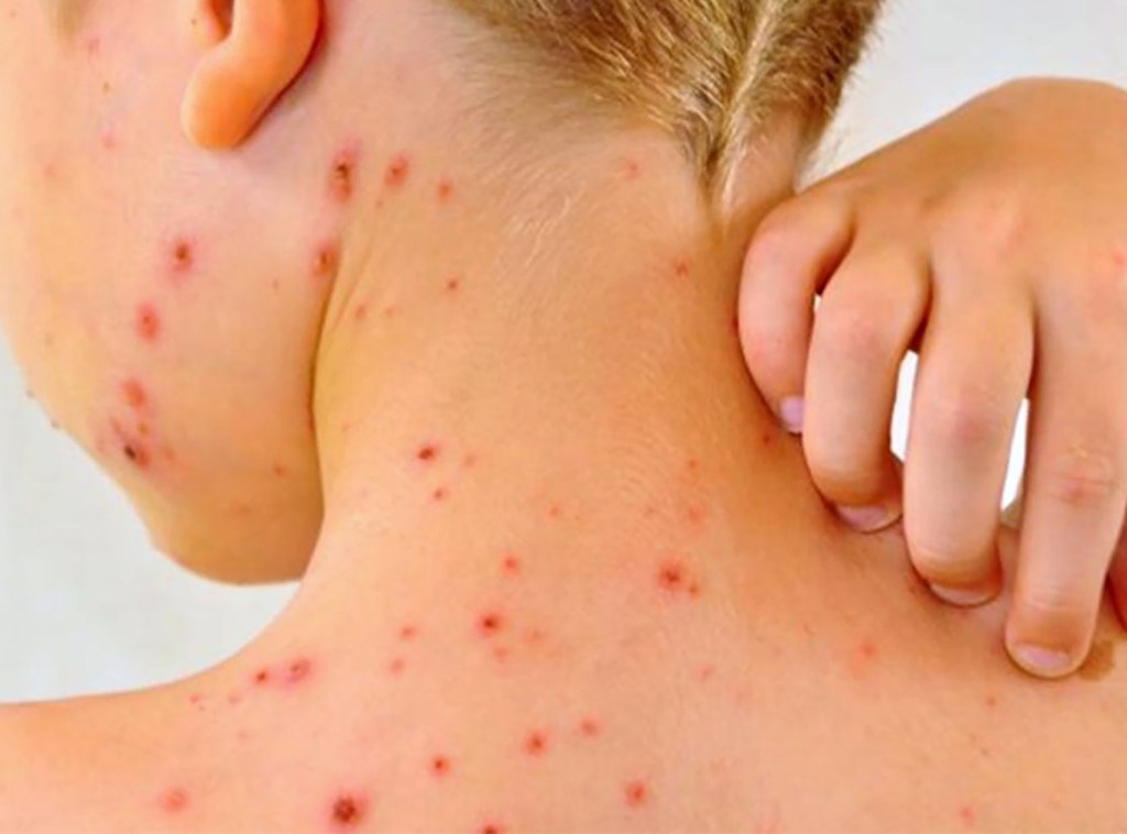 IMSS Yucatán anuncia jornada de vacunación contra sarampión este 21 y 22 de&nbsp;febrero